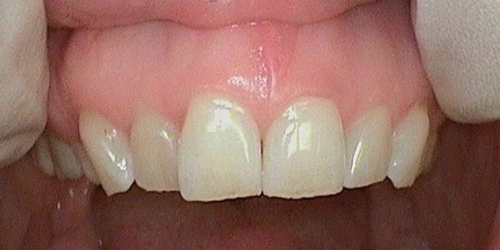Nancy before smile makeover